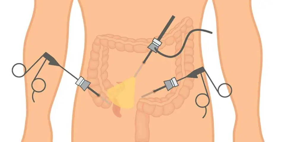 Appendix Surgery